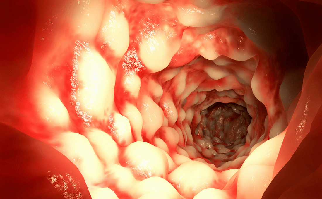 an intestine suffering from IBD